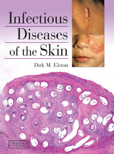 Infectious Diseases of the Skin