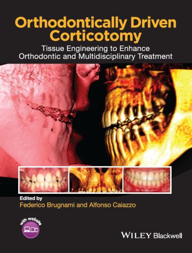 Orthodontically driven corticotomy: tissue engineering to enhance orthodontic and multidisciplinary treatment