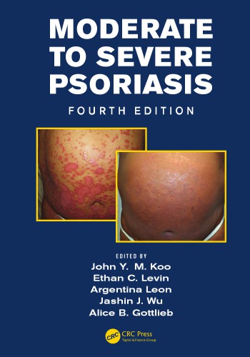 Moderate to Severe Psoriasis, Fourth Edition